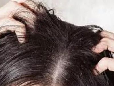 精油小課堂 | 急急急!頭皮調理刻不容緩